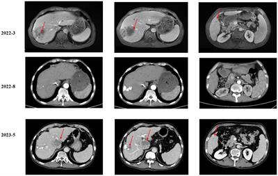 Dramatic response and acquired resistance to savolitinib in advanced intrahepatic cholangiocarcinoma with MET amplification: a case report and literature review